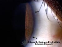 Kayser Fleischer ring in patient with Wilson's disease.